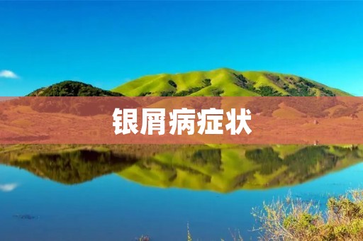 银屑病症状:了解这种常见皮肤病的表现 银屑病症状:了解这种常见皮肤病的表现