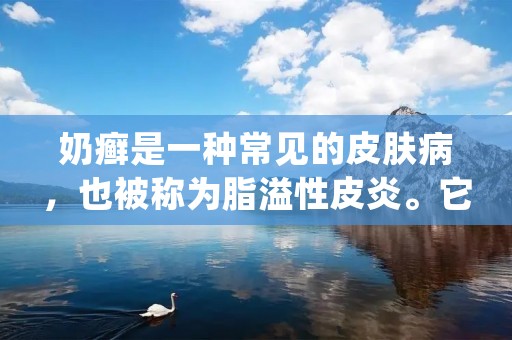 奶癣是一种常见的皮肤病，也被称为脂溢性皮炎。它通常出现在婴儿和成人的头皮上，尤其是在耳后和头发际线附近。虽然这种病不会对健康造成威胁，但它会引起瘙痒和头皮炎症，给患者带来不适。