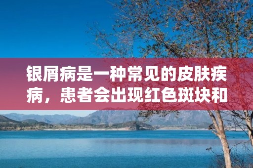 银屑病是一种常见的皮肤疾病,患者会出现红色斑块和银白色鳞屑,常见于头皮、膝盖、肘部等部位。银屑病病因尚不明确,但是与遗传、免疫系统失调、环境因素等有关。目前,银屑病还没有根治的方法,但是可以通过药物治疗、光疗、生物制剂等方法来缓解症状和控制疾病进展。 银屑病是一种常见的皮肤疾病,患者会出现红色斑块和银白色鳞屑,常见于头皮、膝盖、肘部等部位。银屑病病因尚不明确,但是与遗传、免疫系统失调、环境因素等有关。目前,银屑病还没有根治的方法,但是可以通过药物治疗、光疗、生物制剂等方法来缓解症状和控制疾病进展。