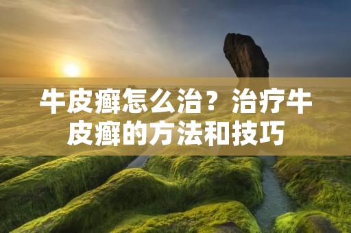 牛皮癣怎么治?治疗牛皮癣的方法和技巧 牛皮癣怎么治?治疗牛皮癣的方法和技巧