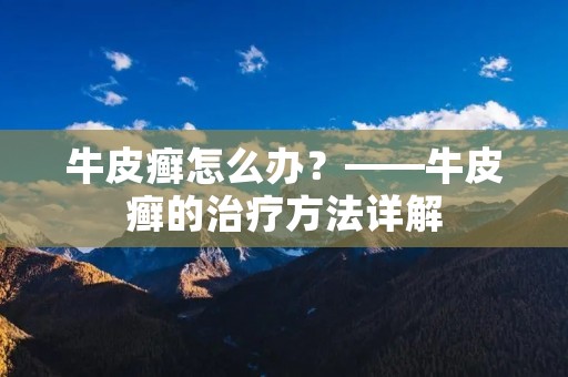 牛皮癣怎么办?——牛皮癣的治疗方法详解 牛皮癣怎么办?——牛皮癣的治疗方法详解