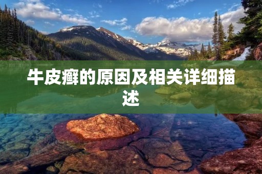牛皮癣的原因及相关详细描述