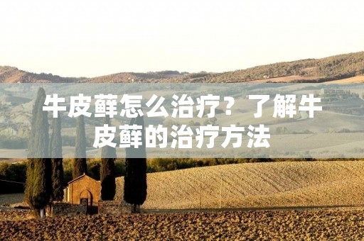牛皮藓怎么治疗?了解牛皮藓的治疗方法