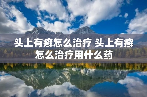 头上有癣怎么治疗 头上有癣怎么治疗用什么药