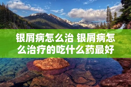银屑病怎么治 银屑病怎么治疗的吃什么药最好
